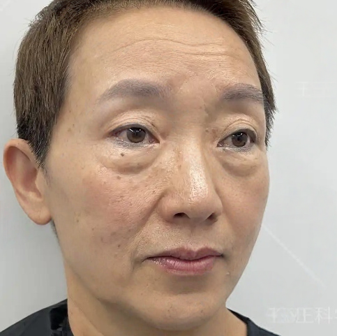 去眼袋手术