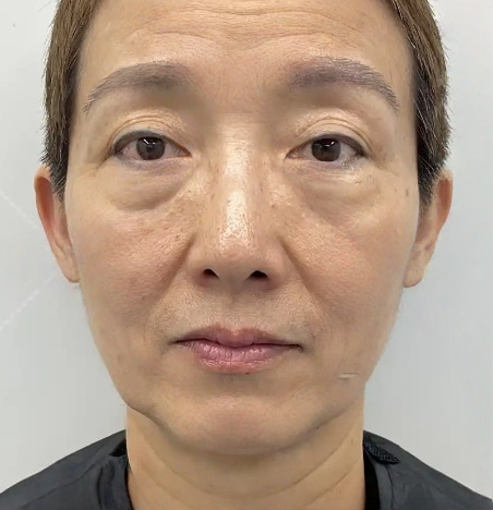 去眼袋手术