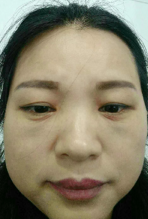 去眼袋手术