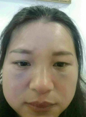 去眼袋手术