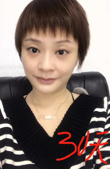 去眼袋手术