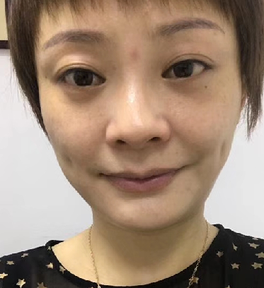 去眼袋手术