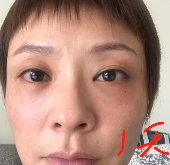去眼袋手术