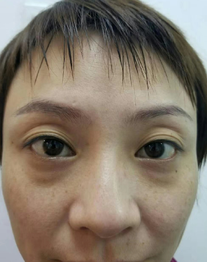 去眼袋手术