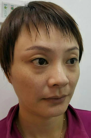 去眼袋手术