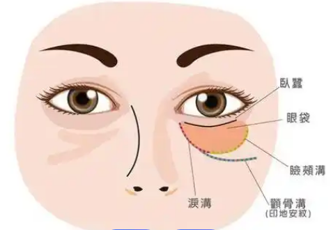 去眼袋手术