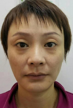 去眼袋手术