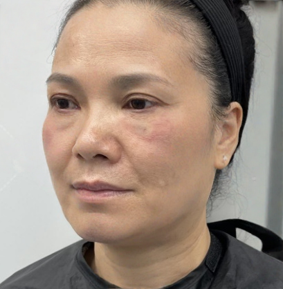 去眼袋手术