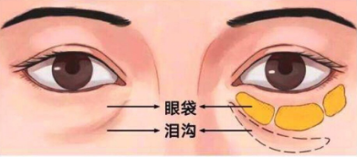 去眼袋手术