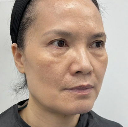 去眼袋手术
