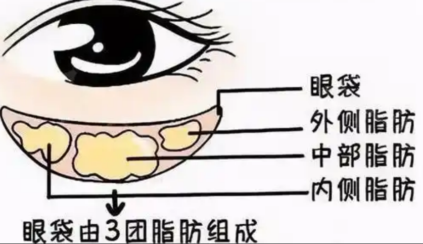 去眼袋手术