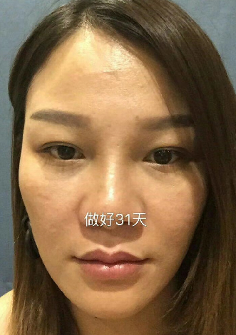 去眼袋手术