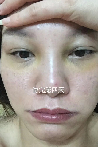 去眼袋手术