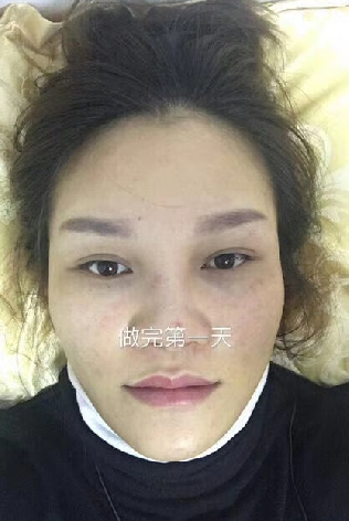 去眼袋手术