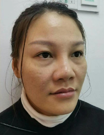 去眼袋手术