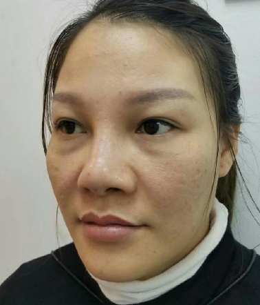 去眼袋手术