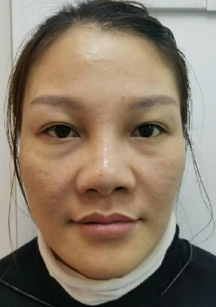 去眼袋手术