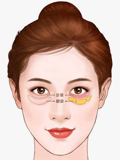 去眼袋手术