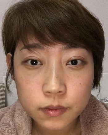 去眼袋手术