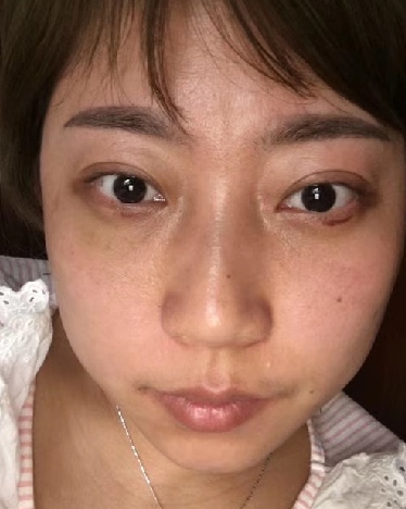去眼袋手术