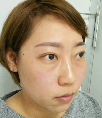 去眼袋手术
