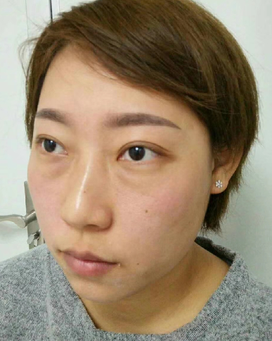 去眼袋手术