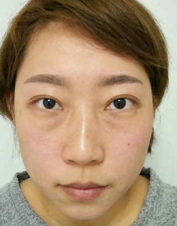 去眼袋手术