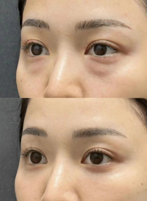 眼袋