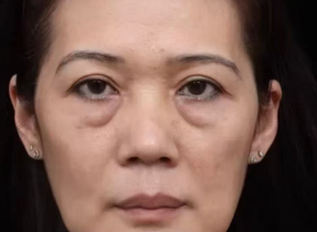 眼袋