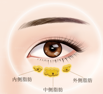 眼袋