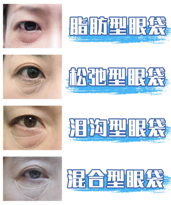 眼袋