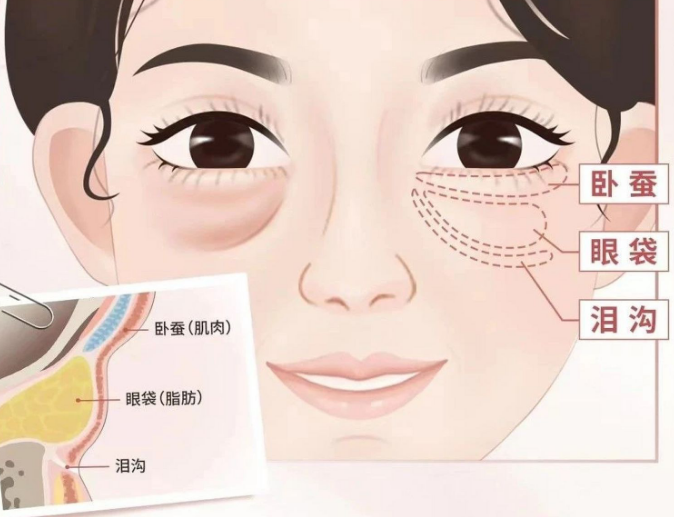 眼袋