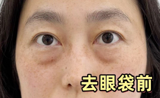 眼袋