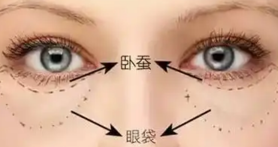 眼袋