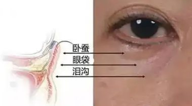 眼袋