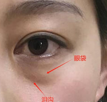 眼袋