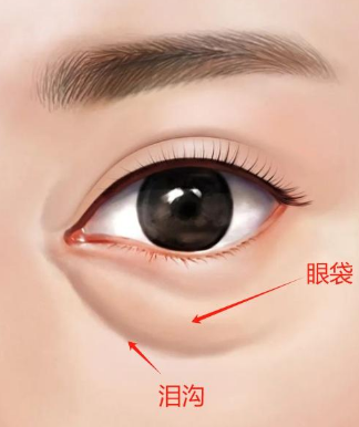 眼袋