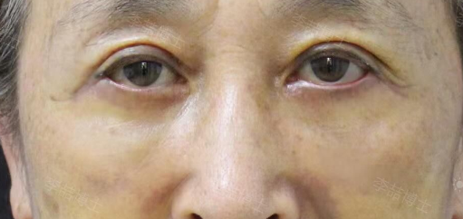 眼袋