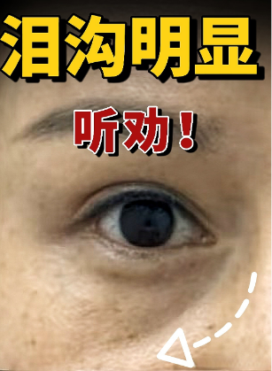 泪沟