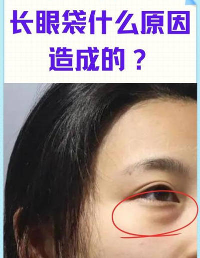 去眼袋手术