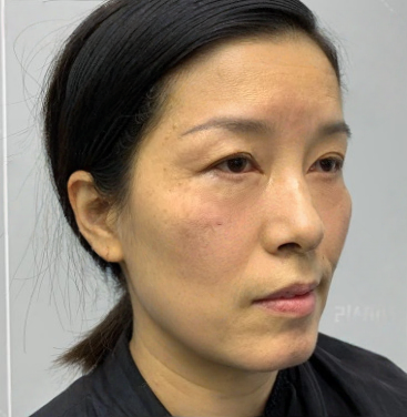 去眼袋手术