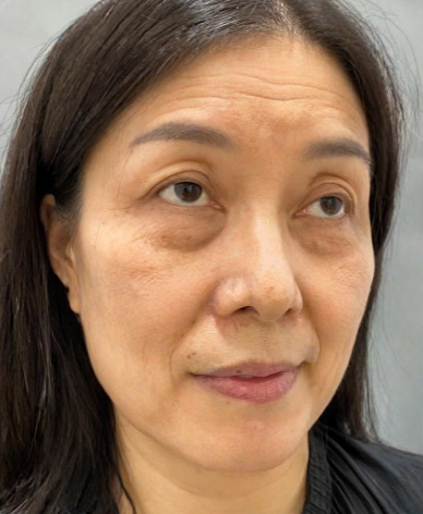 去眼袋手术
