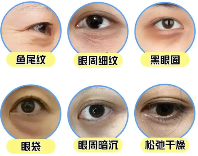 去眼袋手术