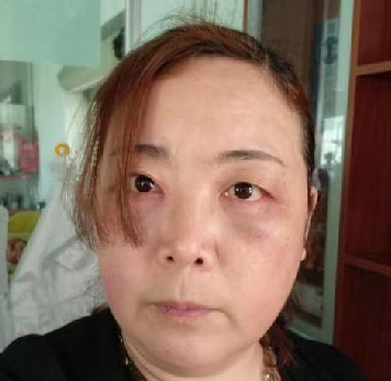 去眼袋手术