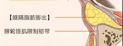 去眼袋手术