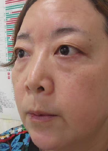 去眼袋手术