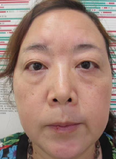 去眼袋手术