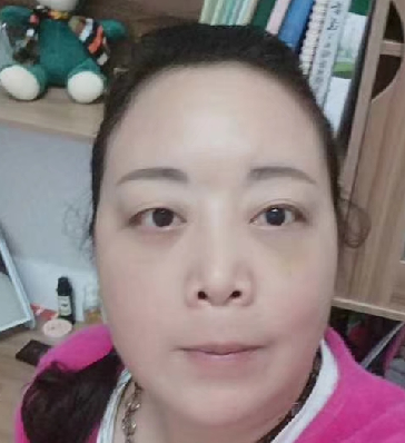 去眼袋手术