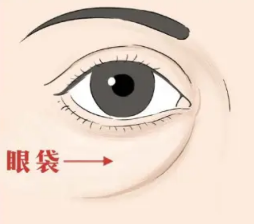 去眼袋手术