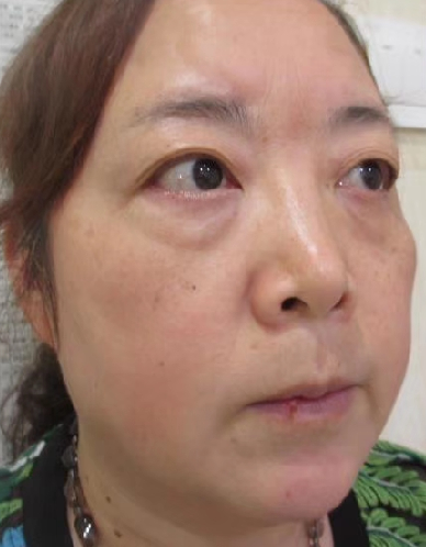 去眼袋手术